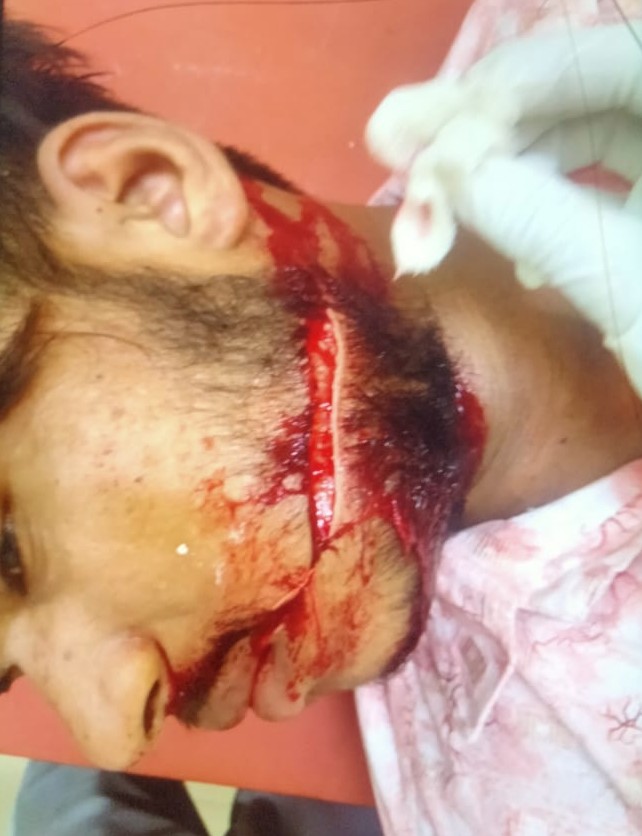 Barabanki: पूर्व सभासद और गुर्गों ने ई-रिक्शा चालक पर चाकू से किया जानलेवा हमला, घटना के बाद इलाक़े में दहशत