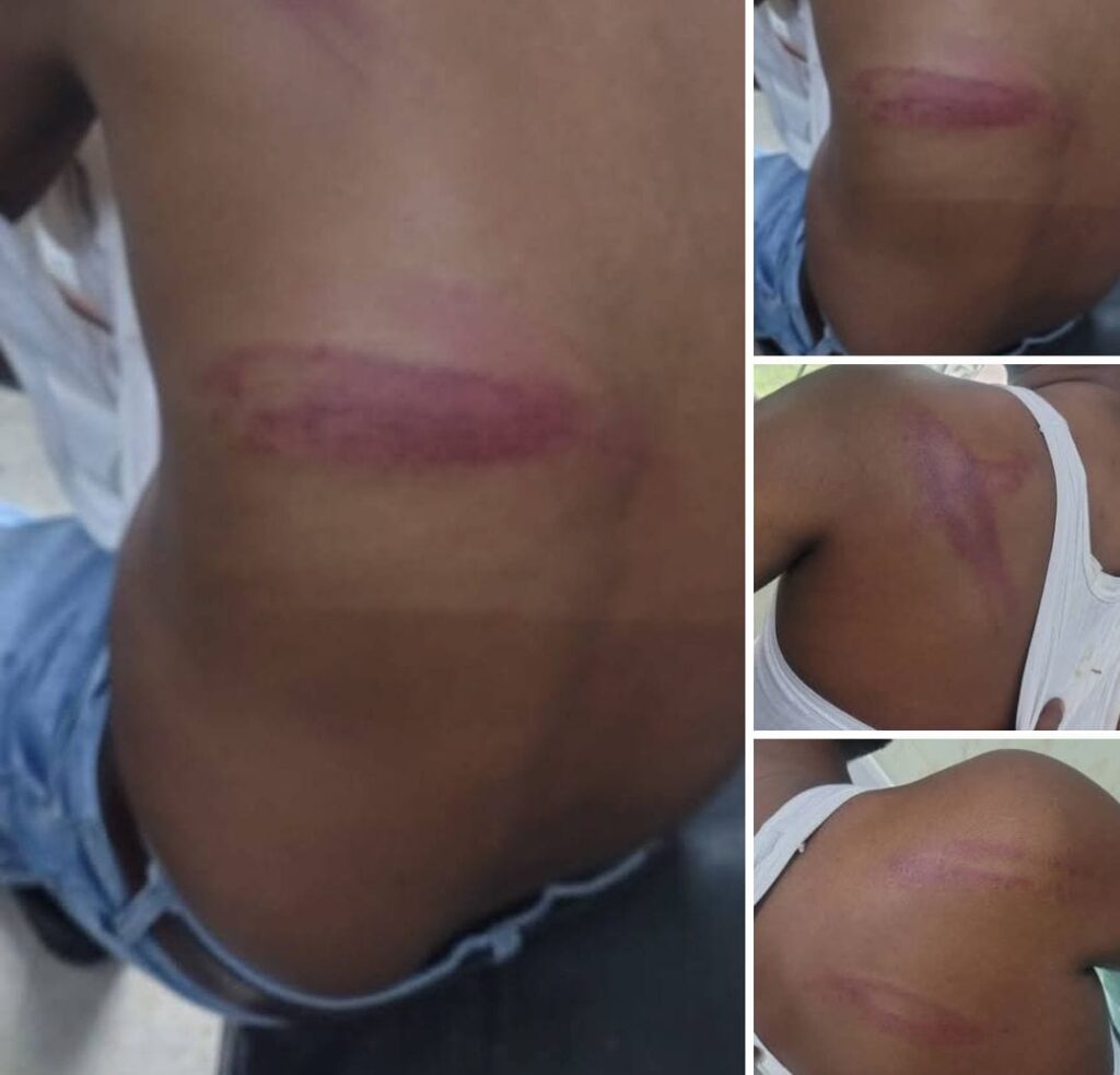 Barabanki: खबर चलाने से नाराज़ दबंगों ने पत्रकार पर किया जानलेवा हमला, दौड़ा-दौड़ा कर लाठी-डंडों से बुरी तरह पीटा