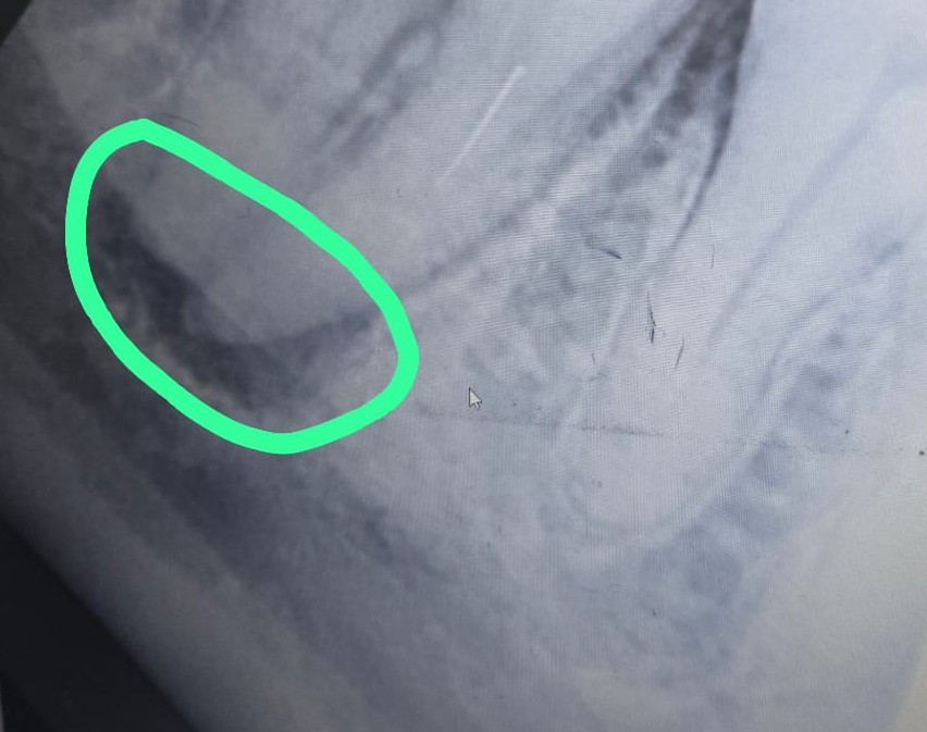 Barabanki News: चंद्रा डेंटल कॉलेज एंड हॉस्पिटल की बड़ी लापरवाही, मरीज़ ने जान जोख़िम में डालने का लगाया आरोप, नगर कोतवाली में दी तहरीर