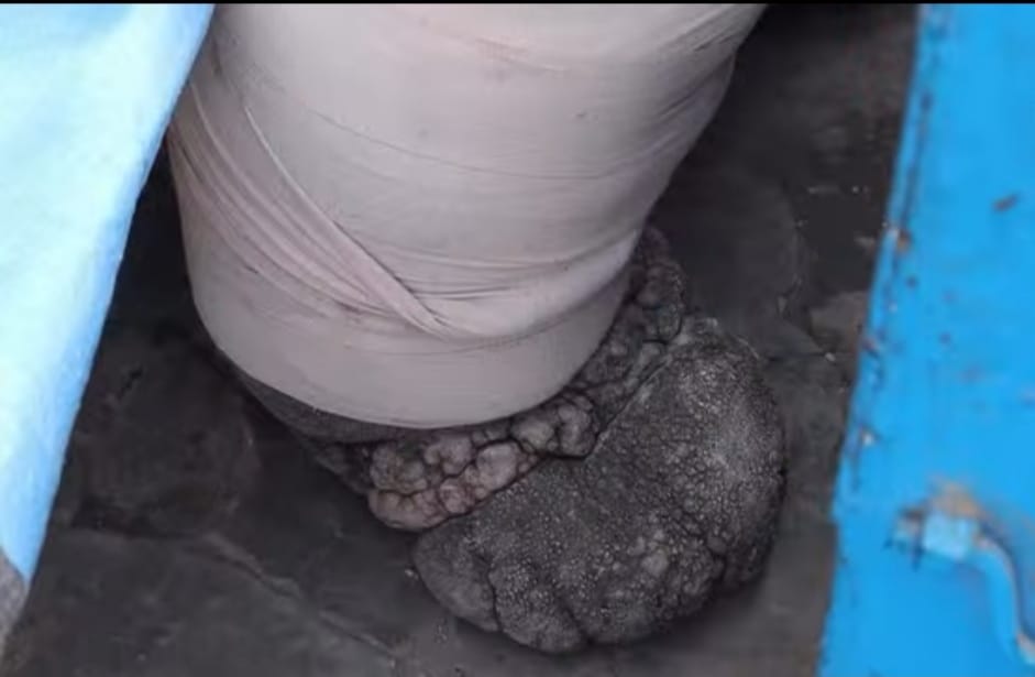 Barabanki: 15 साल से ‘हाथीपांव’ की पीड़ा, फिर न झुका हौसला: मोहम्मद अफजाल बने संघर्ष, हिम्मत और खुद्दारी की मिसाल; पढ़ें संघर्ष और खुद्दारी की मार्मिक कहानी।